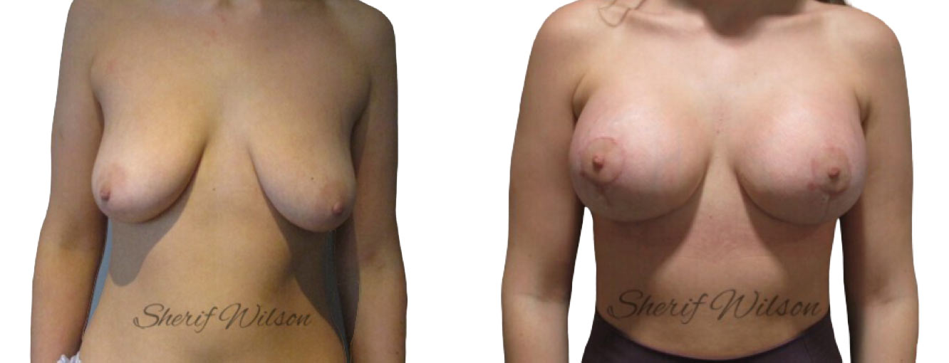 breast augmentation mastopexy before after