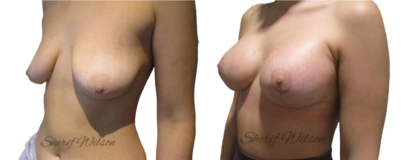 breast augmentation mastopexy before after