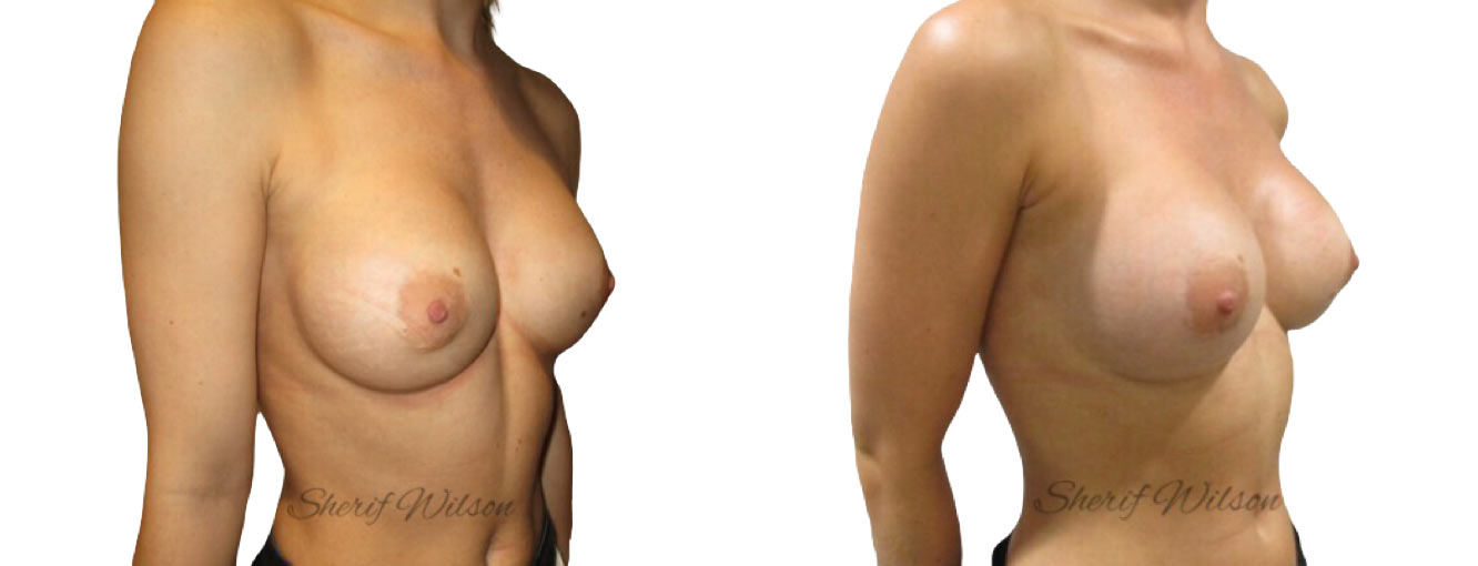 breast implant exchange before after