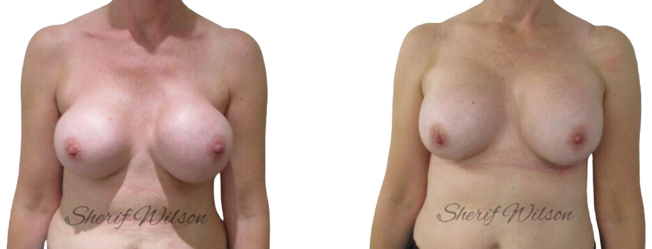breast implant exchange before after