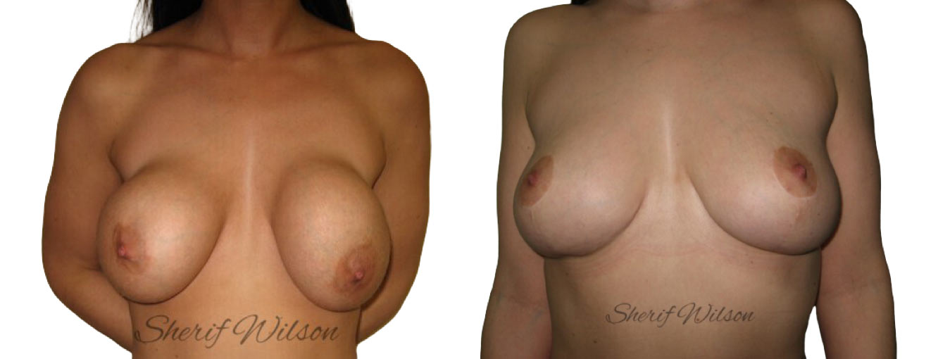 breast implant removal before after