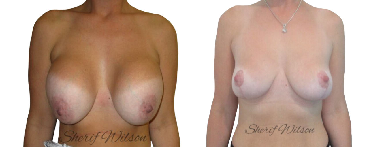 breast implant removal before after