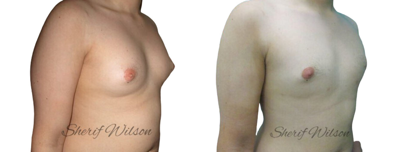male breast reduction before after