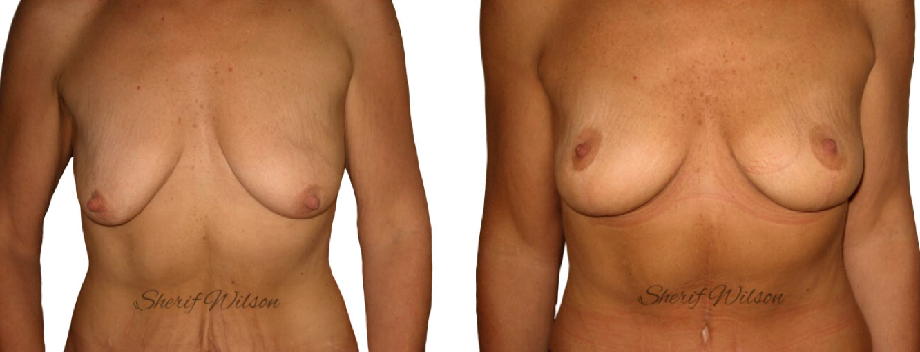 Breast Lift Surgery Before and After