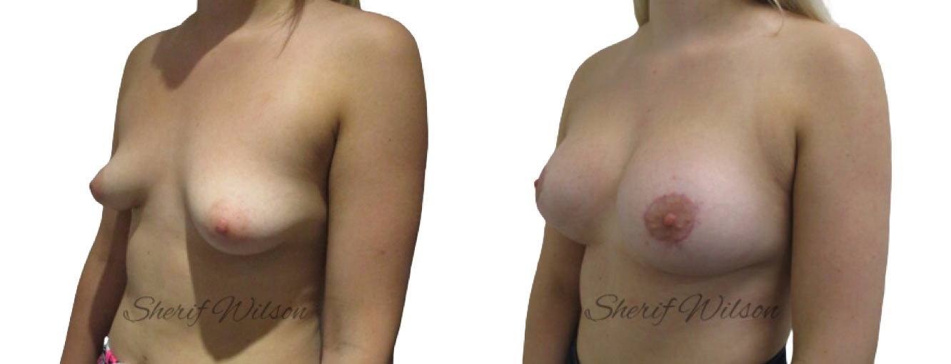 tuberous breast correction surgery before after