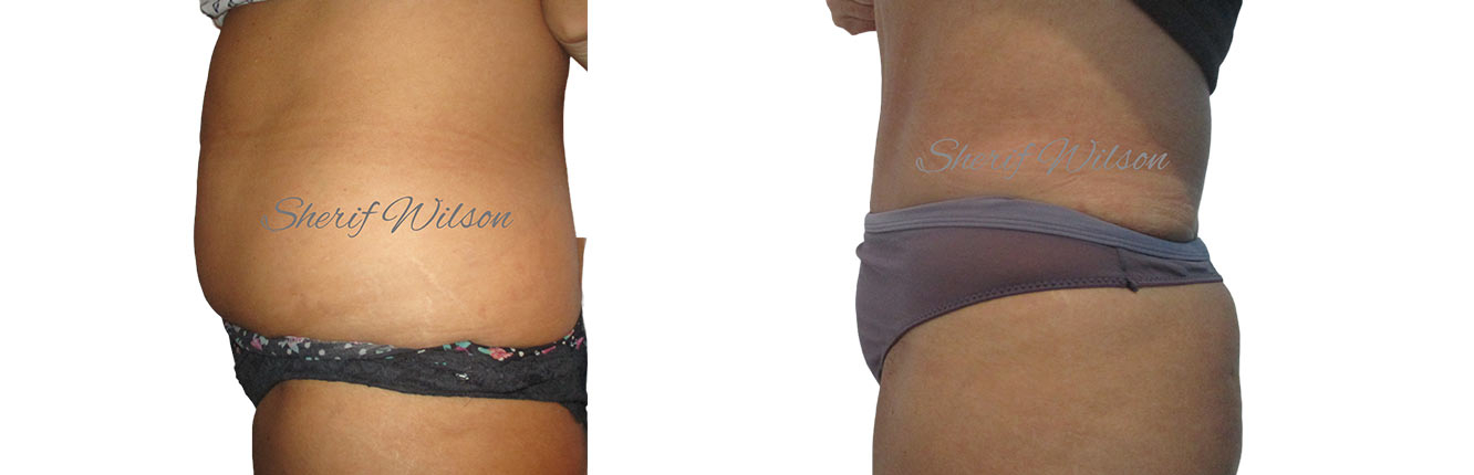 tummy tuck before and after image